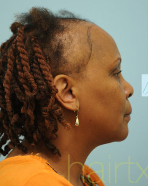 African Hair Transplant