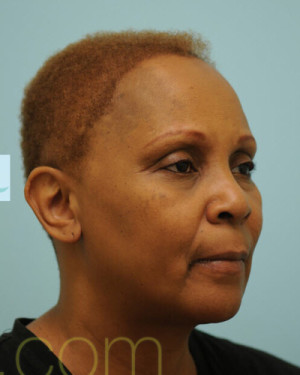 African Hair Transplant