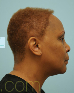 African Hair Transplant