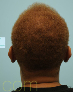 African Hair Transplant