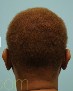 African Hair Transplant