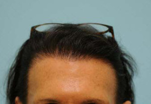 Transgender Hair Transplant