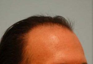 Transgender Hair Transplant