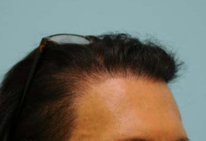 Transgender Hair Transplant