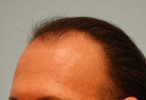 Transgender Hair Transplant