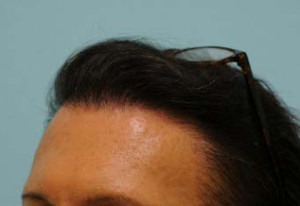 Transgender Hair Transplant