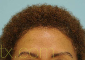 Eyebrow Hair Restoration