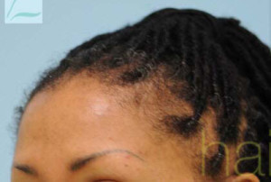 Eyebrow Hair Restoration