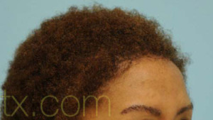 Eyebrow Hair Restoration