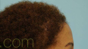 Eyebrow Hair Restoration