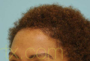 Eyebrow Hair Restoration