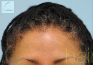 Eyebrow Hair Restoration