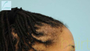 Eyebrow Hair Restoration