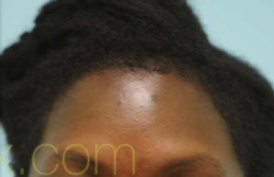 African Hair Transplant