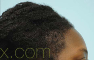 African Hair Transplant