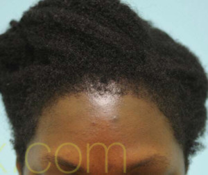 African Hair Transplant