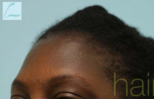 African Hair Transplant