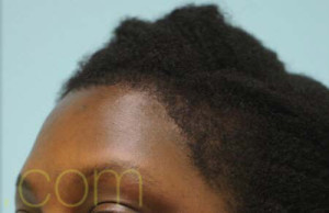 African Hair Transplant