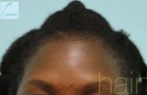 African Hair Transplant