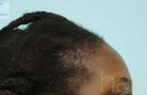 African Hair Transplant