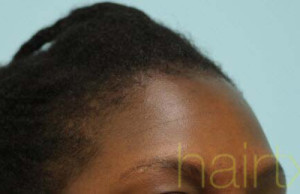 African Hair Transplant