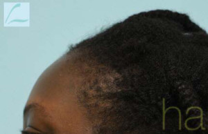 African Hair Transplant