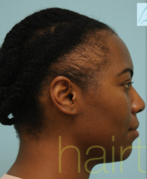 African Hair Transplant