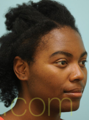 African Hair Transplant