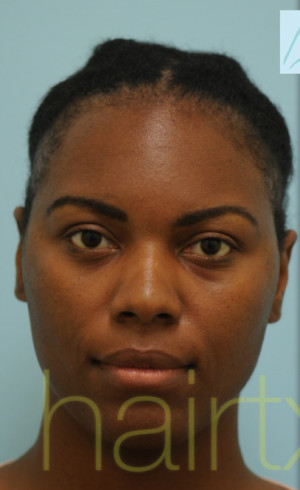 African Hair Transplant
