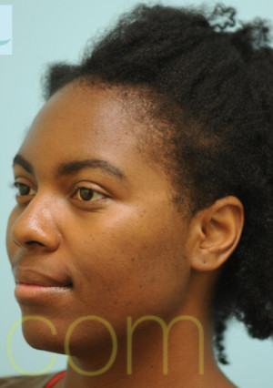 African Hair Transplant