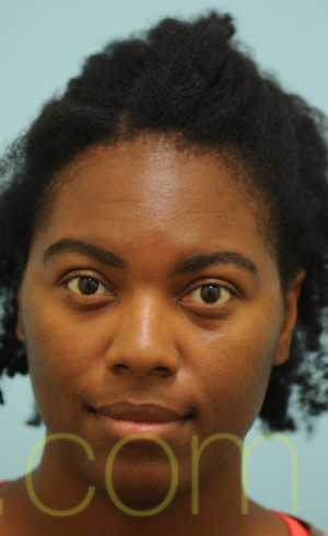 African Hair Transplant
