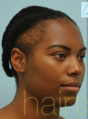 African Hair Transplant