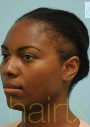 African Hair Transplant