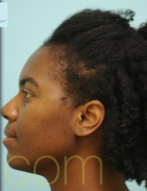 African Hair Transplant