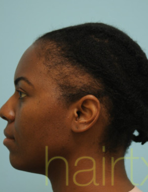 African Hair Transplant