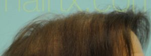 Female Hairline Lowering