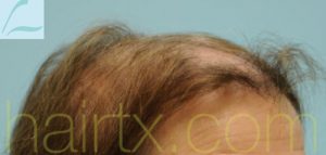 Female Hairline Lowering