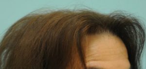 Female Hairline Lowering