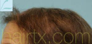 Female Hairline Lowering