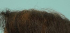 Female Hairline Lowering