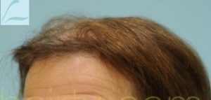 Female Hairline Lowering