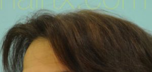 Female Hairline Lowering