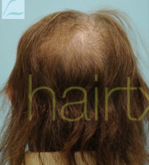 Female Hairline Lowering