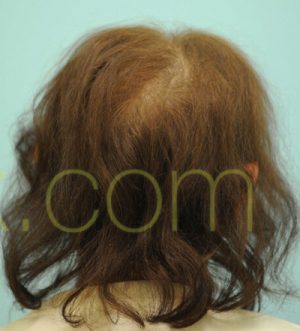 Female Hairline Lowering