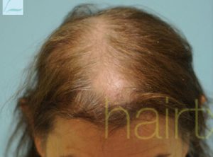 Female Hairline Lowering