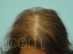 Female Hairline Lowering