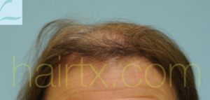 Female Hairline Lowering