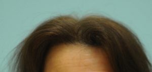 Female Hairline Lowering