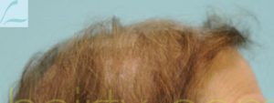Female Hairline Lowering