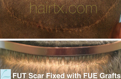 Scarring Series: FUT Scars (How To Avoid Them and How to Manage Them) |  Lam, Sam ()